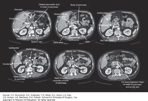 Ct Imaging Of Pancreatic Cancer Accessmedicine Network