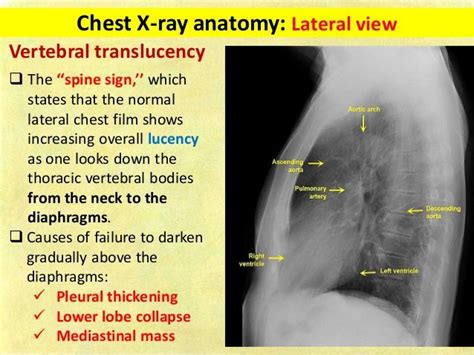 Lateral Chest X Ray Labeled