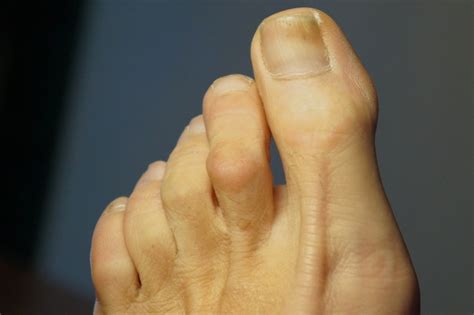 Hammer Toe Time Ii Surgery And Recovery