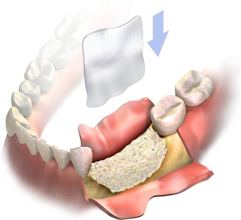 Bone Grafting Overview Materials And Procedure Stomadent