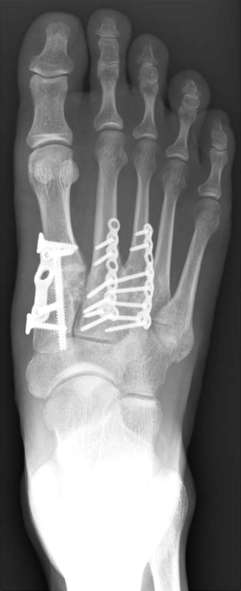 Surgical Treatment Of Lisfranc Injury With Plantar Plate Approach The