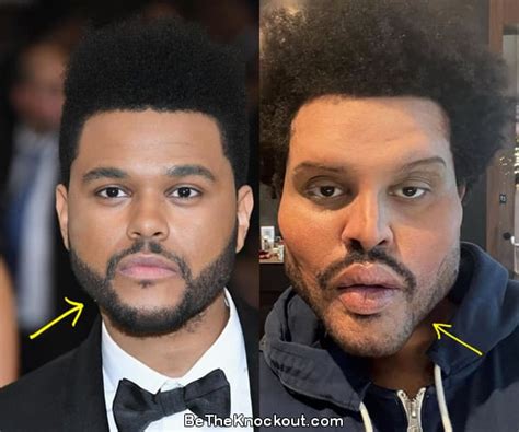 The Weeknd Plastic Surgery Comparison Photos