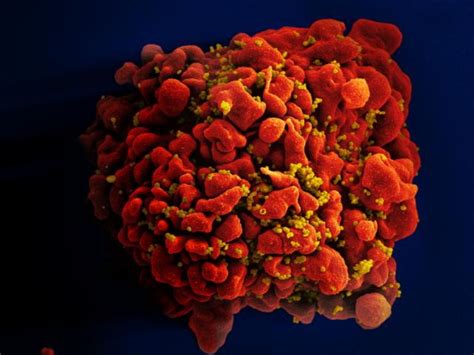Stem Cell Therapy Cures First Woman With HIV Say Researchers