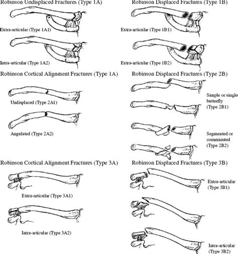 Classification Of Clavicle Fracture