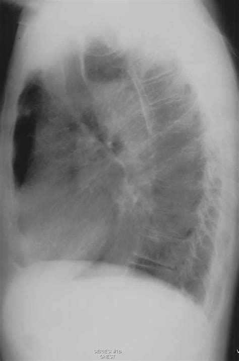 Achalasia On Chest X Ray X Rays Case Studies Ctisus Ct Scanning