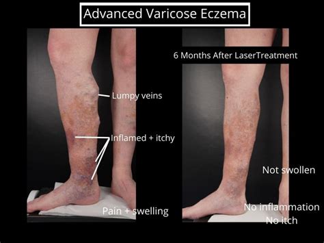 Can Varicose Eczema Be Cured The Veincare Centre
