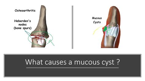 Mucous Cyst Diagnosis And Treatment By Dr Anzarut Youtube