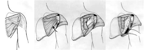 An Extended Posterior Approach Is Utilized To Expose The Glenoid