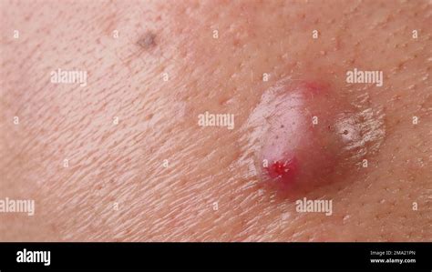 Bacterial Skin Infection Big Acne Cyst Abscess Or Ulcer Swollen Area