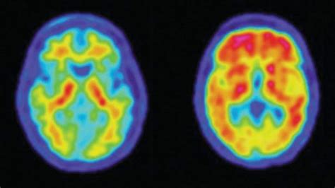 Trial Of New Alzheimers Drug Shows Promising Results The Washington Post