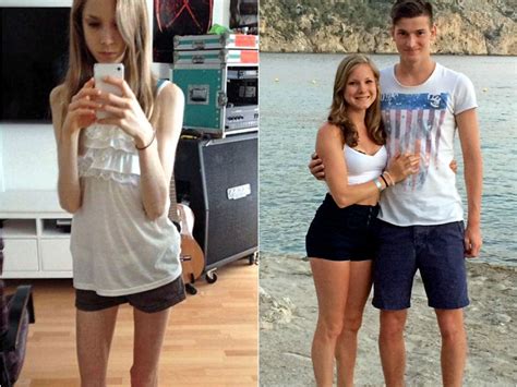 Anorexia Before And After Pictures Of People With Anorexia