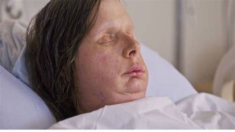 Woman Who Had Face Transplant Following Chimp Attack Opens Up In Documentary Fox News