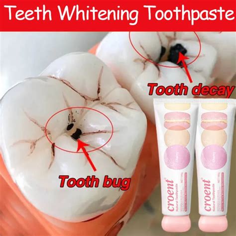Allergy Toothpaste Teeth Tleaning Toothpaste Teeth Whitening Toothpaste