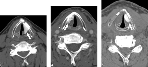 Figure 3 From Ct Assessment Of Vocal Cord Medialization Semantic Scholar
