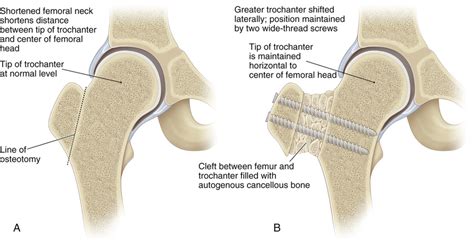8 Lateral Advancement Of The Greater Trochanter Musculoskeletal Key