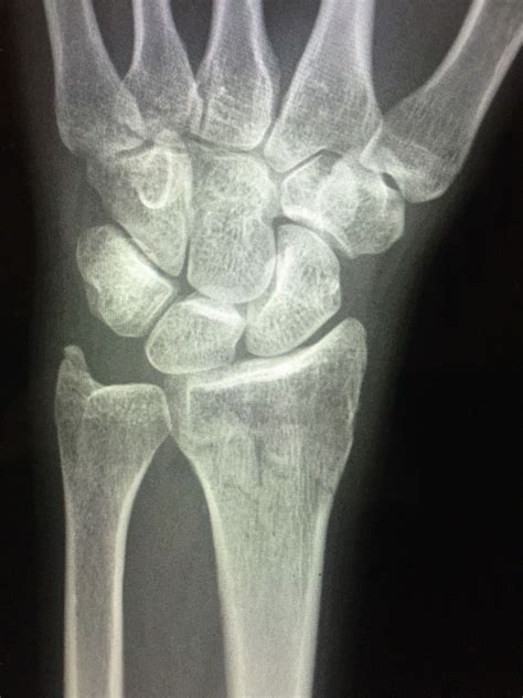 Distal Radius Fracture Wrist Fractures