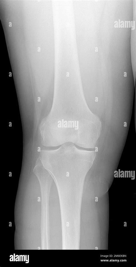Image Of Knee X Ray Detecting Radiographic Knee Osteoarthritis Stock