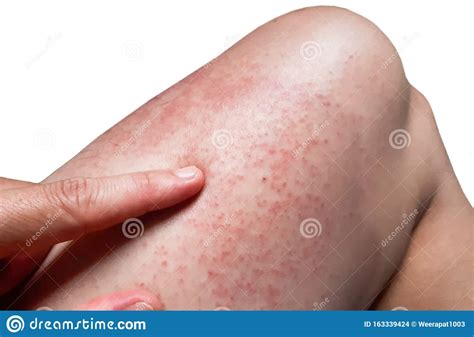 Red Rash On Leg Stock Photo Image Of Irritate Chickenpox 163339424