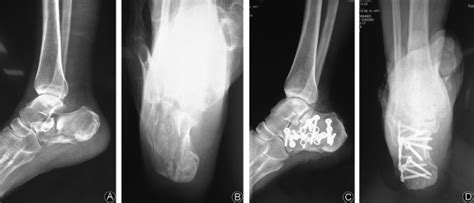 X Ray Images Of Sander Iii Calcaneal Fracture A Preoperative Lateral