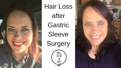 This is because those who undergo gastric bypass or sleeve surgery experience a more rapid weight loss and higher prevalence of nutrient deficiency after surgery. How to prevent hair loss after gastric sleeve surgery ...