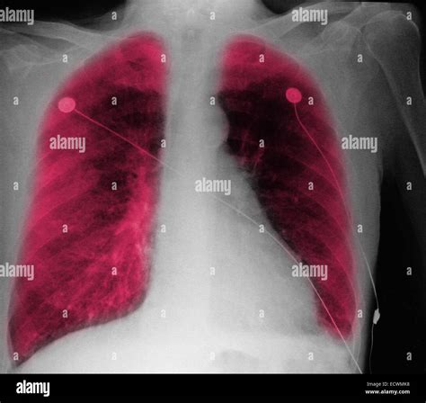 Radiografía De Tórax Mostrando La Insuficiencia Cardiaca Congestiva