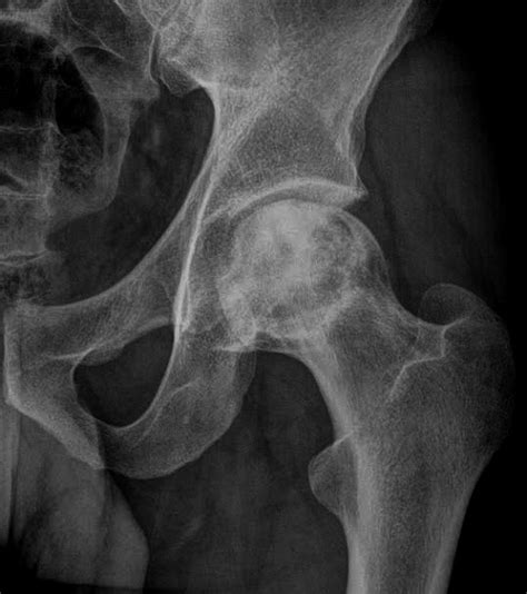 Avascular Necrosis Of Hip Avascular Necrosis Of The Hip In Sickle
