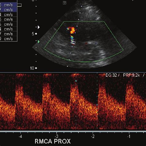3 Transcranial Doppler Ultrasound Study In A Patient With Download