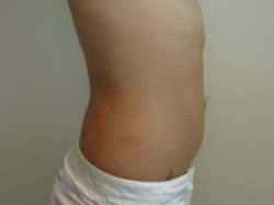 Tampa Bay Tumescent Liposuction Specialist Dr Andres Bonelli