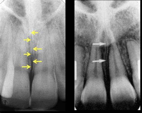 Radiographic Appearance Of Normal Anatomy Of Maxilla And Mandible