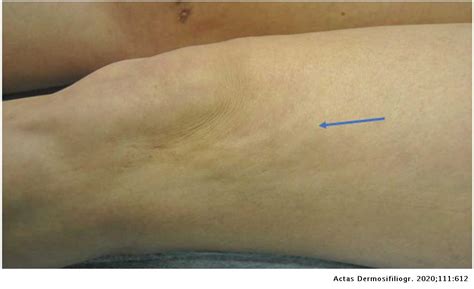 Peau Dorange Appearance Pseudocellulitis And Elastography Actas