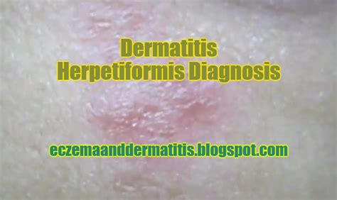 Dermatitis Herpetiformis Diagnosis Eczema And Dermatitis