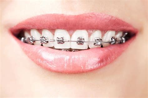 The Health Benefits Of Orthodontic Treatment