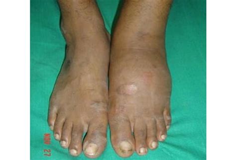 Red Hot And Swollen Foot In Diabetes Charcot Or No
