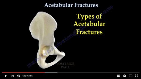 Acetabular Fractures Classification Dnb Orthopaedics Ms Orthopedics