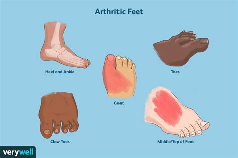 Pictures Of Arthritis In The Feet Signs Symptoms And Risk Factors