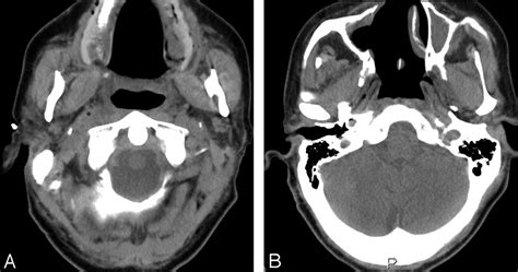 Retropharyngeal Lymph Node Metastasis From Esthesioneuroblastoma A