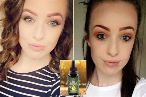 Woman Claims Shes Found Miracle Cure For Severe Eczema That Left Her Housebound And Screaming