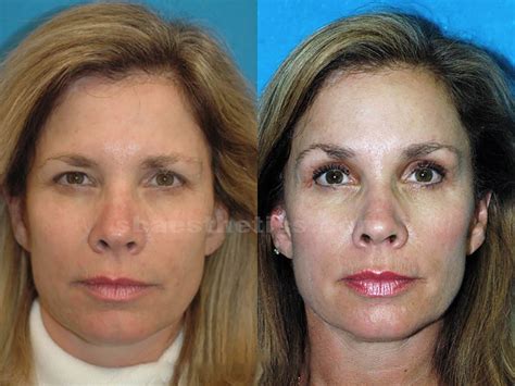Should you get brow botox? Brow Lift Surgery Santa Barbara | Forehead Lift | Dr ...