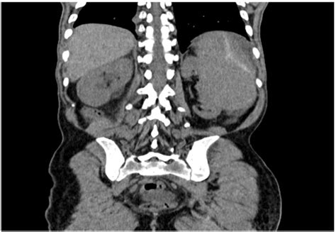 Ct Image Showing Splenomegaly With Subcapsular Hematoma Of The Spleen