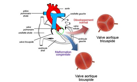 Malformation De La Valve Aortique Un Mécanisme Dévoilé · Inserm La