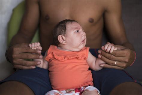 A Simple Explanation Of The Disturbing Birth Defect That May Be Linked With Zika Virus