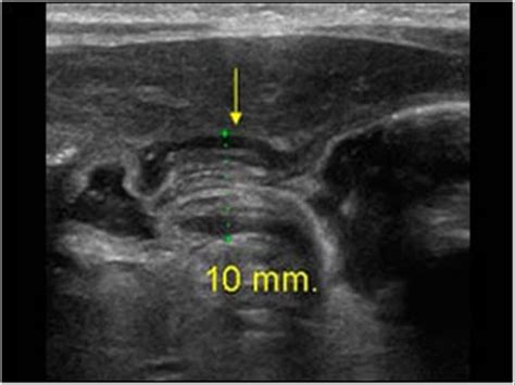 Pyloric Stenosis Ultrasound Protocol