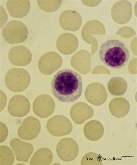 Plasmacytoid Lymphocytes Vs Plasma Cells