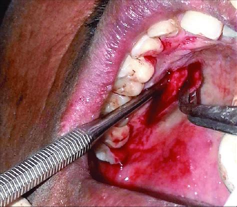Harvesting Of Connective Tissue Graft From Palate By Trap Door
