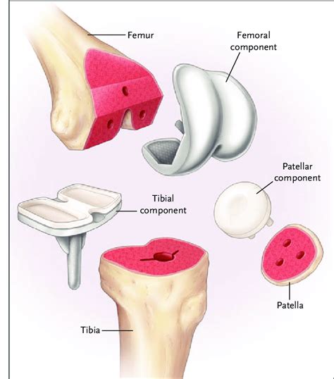Components Of Total Knee Arthroplasty Precise Resections Are Made In Download Scientific