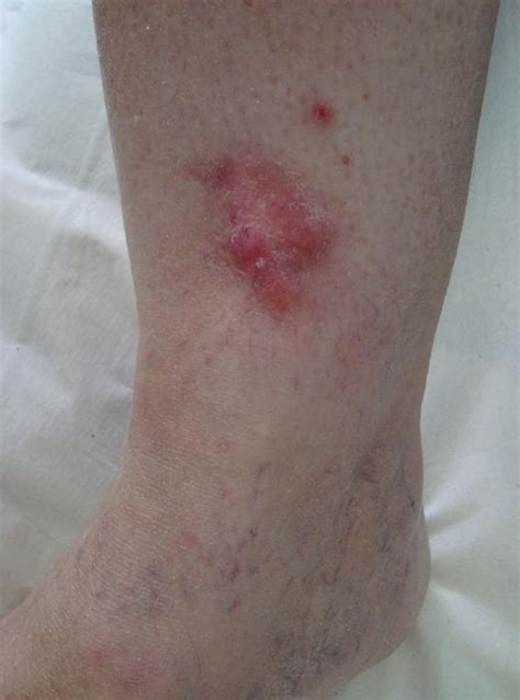 Skin Cancer Sores On Leg