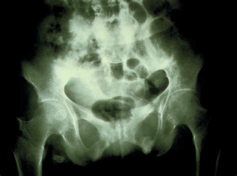 X Ray Of Pelvis In Osteomalacia Photograph By Science Photo Library