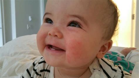 Food Allergy Skin Rush On Babys Face Babycenter