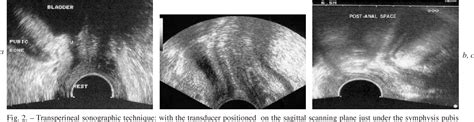 Figure 1 From Sonography Of The Female Pelvic Floor Clinical Indications And Techniques