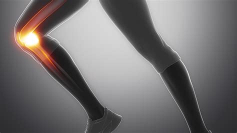 Gonartrosis de rodilla qué es causas síntomas y tratamiento 2023